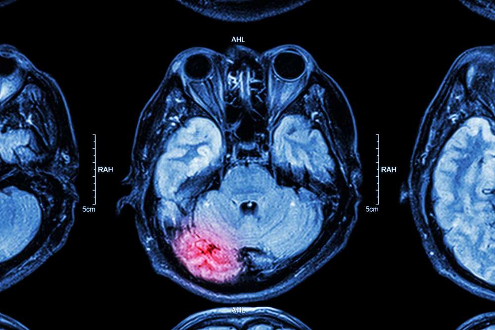 Virginia Traumatic Brain Injury